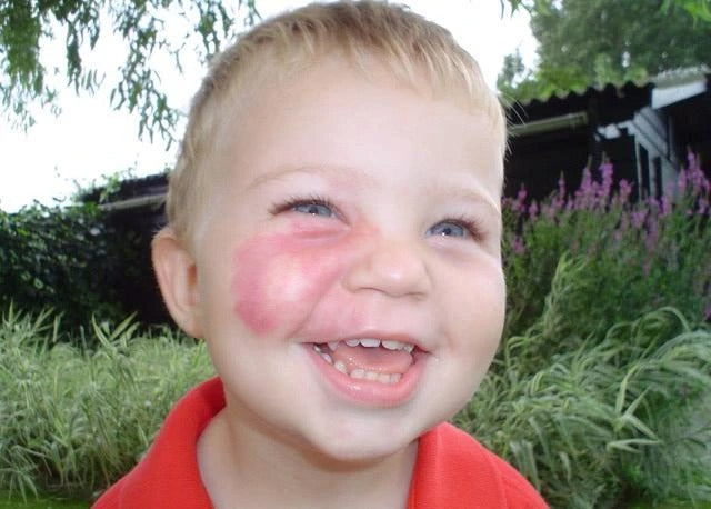 My child has a port-wine stain, what should I do?
