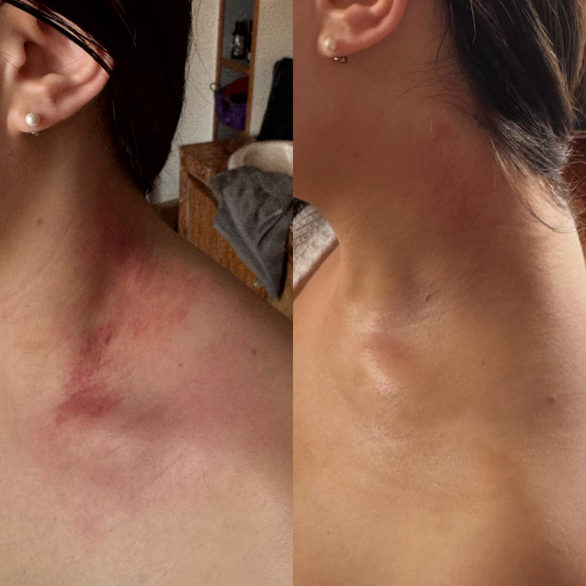 Avant et après : des marques rouges sur le cou et la clavicule, puis la même zone couverte de maquillage